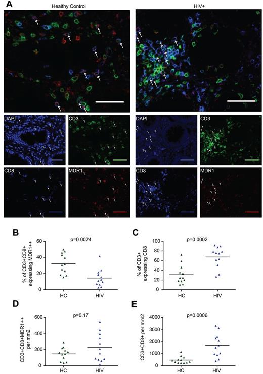 Figure 3. CD161++/MAIT cell analysis in the colon in HIV. Sections of colon from HIV-infected patients (n = 12) or controls (n = 12) were stained for CD3, CD8, and MDR-1. CD161++/MAIT cells were defined as CD3+CD8+MDR1++. (A) Representative images from control (left) and HIV-infected tissue (right) are shown. Arrows indicate CD3+CD8+MDR1++ cells. Scale bars, 50 μm. (B) The proportion of CD3+CD8+ cells expressing high (++) levels of MDR1 was reduced in HIV infection. (C) The proportion of CD3+ cells expressing CD8 was increased in HIV infection. (D) No significant difference was seen in the number of CD3+CD8+MDR1++ cells per mm2. (E) The number of CD3+CD8+ cells per mm2 was increased in HIV infection.