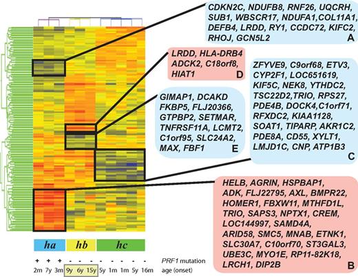 Figure 1. Clustering of FHL patient samples in accordance with the disease phenotype. Patients with FHL type 2 (ha), patients with unknown genetic cause of FHL and relapse (hb), and patients with rapidly evolving form of FHL (hc) were distinguished by the hierarchical clustering of all samples. The blue and red boxes on the right side of the heat map display down- and up-regulated genes, which are clustered according to disease subtypes.
