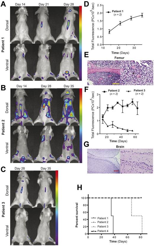 Figure 3. In vivo imaging of primary patient AML xenografts with multiplexed mAbs indicates engraftment status. Four primary AML patient samples (5 × 106 cells) were injected intravenously into irradiated NSG mice (n = 2 per patient sample) and imaged weekly with 3 multiplexed mAbs (CD45/13/HLA ABC, total 1 μg/g, 0.33 μg/g of each antibody). Representative fluorescence images (A-B) and fluorescence quantification (D,F) are shown for patients 1 and 2. All leukemic infiltrates visualized by imaging were confirmed histologically (E,G). Imaging of patient 3 demonstrated transient fluorescence (C), which decreased with time (F), whereas patient 4 (H) did not engraft. In all cases, imaging indicated engraftment success and was confirmed by histology and survival. Scale bars: yellow indicates original magnification of 20×, 0.1 mm; white, original magnification 40×, 0.05 mm.