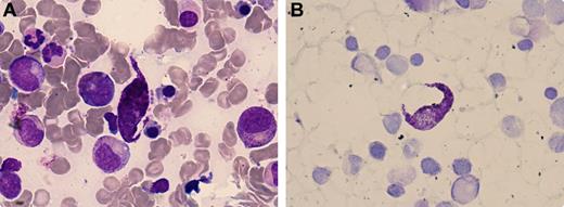 A 57-year-old woman developed an erythematous maculopapular rash on the trunk, abdomen, and thighs without digestive symptoms or lymphadenopathy. Her medical history was significant for osteoporosis with pathologic fractures. Her blood tests showed white blood cells of 10.3 × 109/L, hemoglobin 127 g/L, and platelets 415 × 109/L, with the peripheral blood smear evidencing a slight eosinophilia (0.78 × 109/L). A bone marrow evaluation demonstrated spindle-shaped mast cells sometimes grouped in small clusters (12%) (panel A) with a positive toluidine blue staining (panel B). The histopathologic examination confirmed focal c-kit/CD117+ mast cell accumulation. Serum tryptase level was elevated (183 μg/L). A diagnosis was made of systemic mastocytosis (SM) with skin and bone marrow infiltration. / SM is a rare disease that results from a clonal neoplastic proliferation of abnormal mast cells that accumulate in 1 or more extracutaneous organs. The clinical presentation is heterogeneous, the sine qua non of mastocytosis being the presence of a multifocal cluster infiltration pattern of cells variable in appearance, from round to fusiform variants with long polar cytoplasmic processes. Diagnosis is based on morphologic, immunophenotypic, and/or molecular criteria as outlined by the 2008 World Health Organization (WHO) document. Treatment is generally palliative.