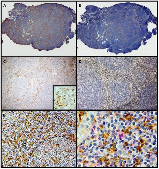 Figure 7. Histiocytes in the T cell–rich zones express PD-L1. Representative follicular lymphoma paraffin sections stained for PD-L1 (5H1) (A,C) and CD3 (B,D). Panels A and C show PD-L1-staining cells predominantly in the T cell–rich zones between the neoplastic follicles. Inset of panel C is a high-power photomicrograph that shows the dendritic process of the 5H1 staining histiocytes. Panels B and D stained for CD3 shown staining predominantly between the neoplastic follicles in the same distribution as the PD-L1-staining cells. Panels E and F show the interfollicular zone stained for PD-L1 (brown) and PD-1 (red). F indicates follicle; IF, interfollicular zone. Hematoxylin counterstain; original magnification ×50 (A-B), ×200 (C-D), ×400 (inset in panel C); ×250 (E), and ×400 (F).