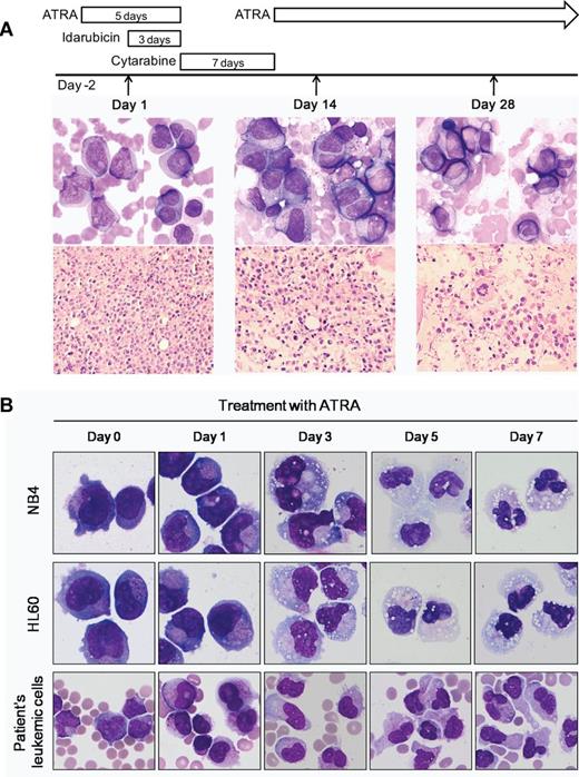 Figure 1. Morphologic features and in vitro ATRA sensitivity of the patient with clonal der(2)t(2;17)(q32;q21). (A) Day 1 (left panel): peripheral blood smear shows abnormal promyelocytes with bi-lobed or sharply indented nucleus and microgranulated cytoplasm. Some promyelocytes have Auer rods (Wright-Giemsa, ×1000). Core biopsy shows hypercellular bone marrow infiltrated by leukemic cells with high nucleocytoplasmic ratios and indented or irregular nuclear contours (H&E, ×400). Day 14 (middle panel): bone marrow touch preparation shows persistence of blasts and abnormal promyelocytes in addition to a few myelocytes or metamyelocytes (Wright-Giemsa, ×1000). Conversely, core biopsy reveals more differentiated granulocytes (H&E, ×400). Day 28 (right panel): bone marrow examination shows normocellular marrow with complete differentiation. (B) Leukemic cells of the patient show neutrophilic differentiation with 1μM ATRA treatment. ATRA induces differentiation of NB4 and HL60 cells. (Wright-Giemsa, ×1000). The image was acquired using a BX51 microscope (Olympus), ×1000 and ×400 lenses, and a DP25 digital camera (Olympus).