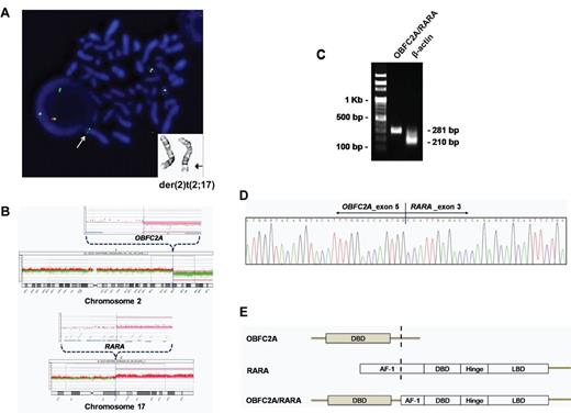 Figure 2. Identification of a novel OBFC2A/RARA fusion gene by FISH, array CGH, RT-PCR and direct sequencing. (A) Representative partial karyogram shows der(2)t(2;17)(q32;q21). FISH with the RARA break-apart probe reveals a 3′ RARA green signal on der(2), indicated by arrows. (B) Array CGH demonstrates that the breakpoints corresponding to a loss in 2q32.3-qter and a gain in 17q21.2-qter map to the OBFC2A and RARA genes. (C) The OBFC2A/RARA fusion transcript is amplified with an internal control (β-actin) by RT-PCR. (D) Partial nucleotide sequences surrounding the OBF2CA/RARA fusion region reveal the junction of OBFC2A exon 5 and RARA exon 3. (E) Schematic diagram represents the OBFC2A, RARA, and OBF2CA/RARA fusion proteins, including the activation function-1 (AF-1), DNA-binding domain (DBD), hinge, and ligand-binding domain (LBD).