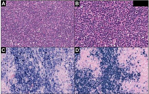Figure 1. Atypical plasma cell hyperplasia in the lymph nodes (case 3). (A) The lesion is characterized by sheets of plasma cells expanding the interfollicular areas admixed with small lymphocytes, plasmacytoid lymphocytes, immunoblasts, and histiocytes. (B) Plasma cells range from morphologically mature to atypical, enlarged forms with nucleoli. In situ hybridization for κ (C) and λ (D) shows similar numbers of positive cells. Panel A, H&E staining; original magnification, 200×. Panel B, H&E staining; original magnification, 400×. Panels C and D, in situ hybridization; original magnification, 200×. Slides were scanned using Ventana iScan Coreo scanner (Ventana Medical Systems Inc), and Image Viewer Version 3.1.1. program was used to capture the images. Final image preparation was performed with Adobe Photoshop CS5 Extended Version 12.1x64.