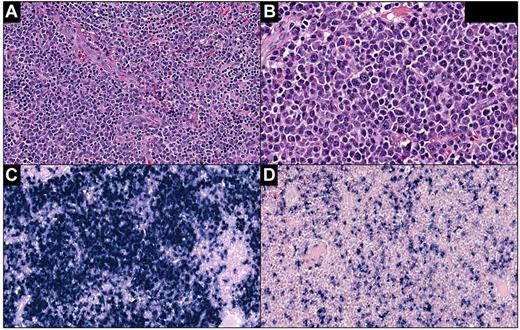 Figure 2. Plasmacytoma-like lesion in the tonsil (case 5). (A) Architecture of the tonsil is completely effaced by sheets of atypical plasma cells. (B) The majority of plasma cells are large with prominent nucleoli. In situ hybridization for κ (C) and λ (D) shows κ light-chain restriction. Panel A, H&E staining; original magnification, 200×. Panel B, H&E staining; original magnification, 400×. Panels C and D, in situ hybridization; original magnification, 200×. Slides were scanned using Ventana iScan Coreo scanner (Ventana Medical Systems Inc), and Image Viewer Version 3.1.1. program was used to capture the images. Final image preparation was performed with Adobe Photoshop CS5 Extended Version 12.1x64.