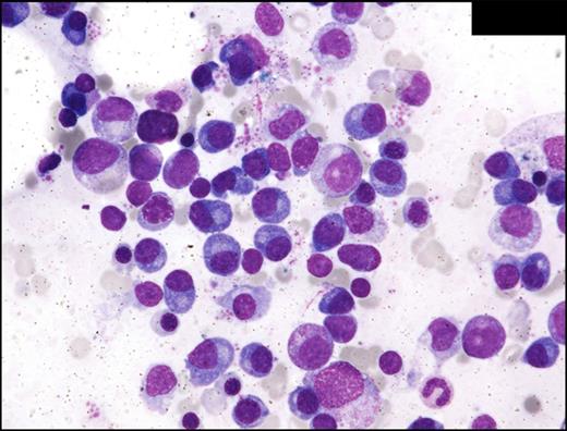 Figure 3. Multiple myeloma (case 4). BM aspirate smear shows numerous atypical, enlarged plasma cells. Wright-Giemsa staining, oil; original magnification, 600×. Photomicrographic images were acquired with a Nikon Eclipse E600 microscope equipped with Nikon DS-Fi1 camera and software. Final image preparation was performed with Adobe Photoshop CS5 Extended Version 12.1x64.