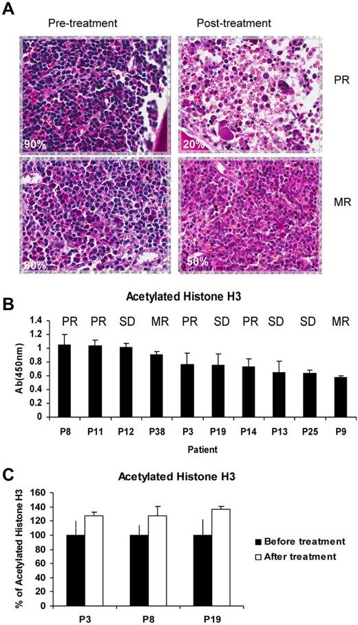 Figure 4. Correlative studies on samples obtained from patients treated with panobinostat. (A) Immunohistochemistry for CD20 and percentage BM involvement in pre- and posttreatment samples. (B) ELISA for acetylated histone 3 (H3) in PBMCs of samples before therapy in 10 patients with the clinical responses that were obtained in these patients. (C) ELISA for acetylated H3 in PBMCs of samples before and after therapy in 3 patients. Although the levels before and after therapy were not statistically different, there was a trend of increases in the level of acetylated H3 after therapy that is consistent with the activity of HDAC inhibitors.