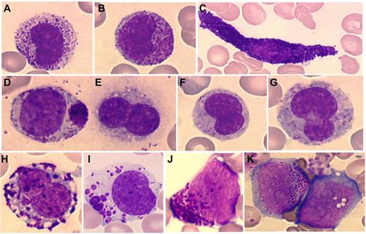Figure 1. Cytologic abnormalities of mast cells in MCL. Mast cells from MCL range from mature mast cells (A-D) to more immature cells with (E-I) promastocytes and (J-K) even metachromatic or (K) ungranulated blasts. (A-B) Circulating round mast cells; (C) spindle-shaped mast cell; (D) packed and polar granule aggregates; (E-G) degranulated/hypogranulated promastocytes; (H-I) coalescent granules; (I) lacunar cytoplasmic areas; (J-K) undifferentiated immature cells with metachromatic granules and prominent nucleoli.