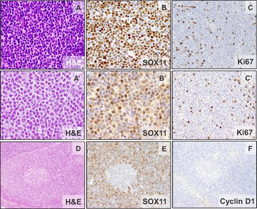 Figure 1. Morphologic and IHC features of cyclin D1− MCL. Patients ID38 (CCND2 translocation–negative) and ID44 (IGK-CCND2 translocation–positive). (A-A′) Monomorphic small- to medium-sized cells with slightly irregular hyperchromatic nuclei (H&E; 400×). (B-B′) Nuclear positivity for SOX11. (C-C′) The cellular proliferation marker Ki67 shows positivity in 10%-20% of the neoplastic cells (IHC; 200×). (D) Cyclin D1− MCL with mantle zone growth pattern (ID42). Note the expanded mantle zone (H&E; 100×). (E-F) SOX11 is strongly positive (E) and cyclin D1 is not expressed in the neoplastic cells (F; IHC; 100×).