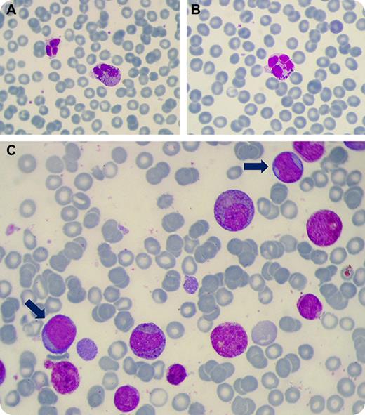A 37-year-old man with no significant past family or personal medical history was admitted to the hospital for persistent eosinophilia detected during a routine check-up. He denied recent travel and was not a smoker, alcoholic, or drug addict. He did not have any history of allergic disease and was not exposed to any toxins or pesticides. Physical examination was normal. His complete blood examination revealed hemoglobin 122 g/dL, total leukocyte count 9 × 109/L with an absolute eosinophil count of 6 × 109/L; platelet count was 200 × 109/L. A peripheral blood film showed many morphologic abnormalities of eosinophils, including of size, granulation, and nuclear lobulation (panels A-B). Red blood cells and platelets were normal and there were no circulating blast cells. The bone marrow exhibited 45% to 55% eosinophilic hyperplasia and 30% of myeloid blast cells (panel C; blue arrows show blast cells). Abnormal eosinophils with dysplastic granules were present. / Molecular analysis on peripheral blood cells showed the rearrangement of FIP1L1-PDGFRA fusion gene. Other hematologic neoplasms or reactive eosinophilia were excluded. The patient was diagnosed with myeloproliferative neoplasm with eosinophilia and abnormalities of PDGFRA (according to the 2008 World Health Organization's Classification of Tumors of Hematopoietic and Lymphoid Tissues) with acute myeloid leukemia (AML). Most cases with rearranged PDGFRA have persistent chronic eosinophilia, but presentation as AML is uncommon. The patient responded to an earlier use of a tyrosine kinase inhibitor (Imatinib).