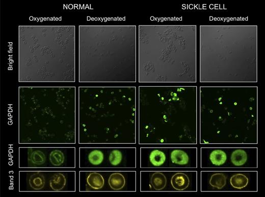 Figure 6. O2-dependent cytosol/membrane migration of GAPDH is absent in SSRBCs. Confocal immunofluorescent imaging was used to observe GAPDH migration in intact RBCs during O2 loading/unloading. Washed RBCs were either fully oxygenated (HbO2% > 95%) or deoxygenated (HbO2% < 20%), fixed under appropriate gas tensions, probed for GAPDH (green) or cdB3 (yellow; see “Methods”), and confocal images were obtained (FluoViewFV1000 Olympus confocal microscope, PlanApo 60×/1.40 oil objective; Flouview acquisition software; imaging medium Prolong Gold). Membrane-based location of cdB3 is easily visualized in all images from both SS and normal RBCs. SSRBCs fail to demonstrate normal O2 content–dependent migration of GAPDH from cytosol to membrane, as demonstrated in normal RBCs on oxygenation.