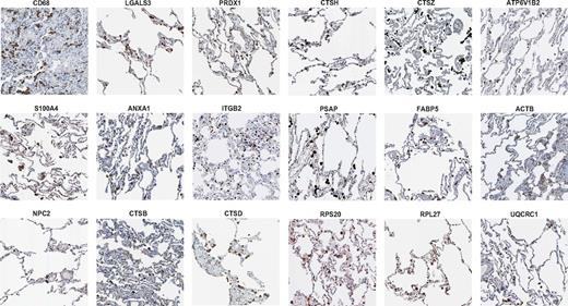 Figure 3. The consistent macrophage signature predicts in situ macrophage-specific expression in human tissues. The gene signature of resting macrophages detected by proteomics and microarray ranking can be detected in lung-resident tissue macrophages. Shown are selected immunohistochemical stainings from human lung tissue using antibodies against CD68, Galectin-3 (LGALS3), Peroxiredoxin (PPRDX1), S100A4, Annexin A1 (ANXA1), ITGB2 (Integrin β 2, CD18), Niemann Pick type C2 (NPC2), cathepsins (CTSB, CTSD, CTSH, CTSZ), ATPase, H+ transporting, lysosomal V1 subunit B2 (ATP6V1B2), Prosaposin (PSAP), fatty acid binding protein 5 (FABP5), actin β (ACTB), ribosomal protein S20 (RPS20), ribosomal protein L27 (RPL27), and the mitochondrial protein ubiquinol-cytochrome c reductase core protein (UQCRC1). Data were generated with the Human Protein Atlas and staining was selected only if the antibodies had supportive scores for immunohistochemistry.