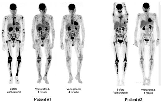 Figure 1. Sequential PET. Patient no. 1 (left): Sequential PET showing high initial pathologic uptake of 18F-fluorodeoxyglucose in soft tissue and bones before vemurafenib treatment, and significantly less uptake after 1 month and major regression after 4 months of vemurafenib treatment. Patient no. 2 (right): Similar substantial reduction of 18F-fluorodeoxyglucose uptake in all tissues involved. Reconstruction algorithm: OSEM_3D (5 iterations, 16 subsets, 9 mm Gauss filter). Volume rendering: Maximum Intensity Projection (Osirix Software). Display: BW inverse logarithmic table and range (min value = 0, max = 2.7 for SUV).