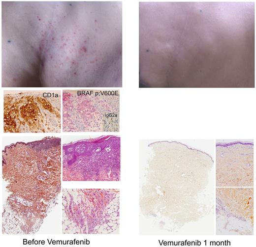 Figure 2. Skin lesions. LCH skin lesions in patient no. 2 disappeared after a few days of treatment with vemurafenib. Skin biopsy before treatment showing typical LCH infiltration of the epidermis and papillary dermis with CD1a+ histiocytes; the hypodermis is infiltrated by foamy CD68+CD1a− histiocytes (as in the peritoneal biopsy). Immunohistochemistry confirmed the expression of BRAF by histiocytes.