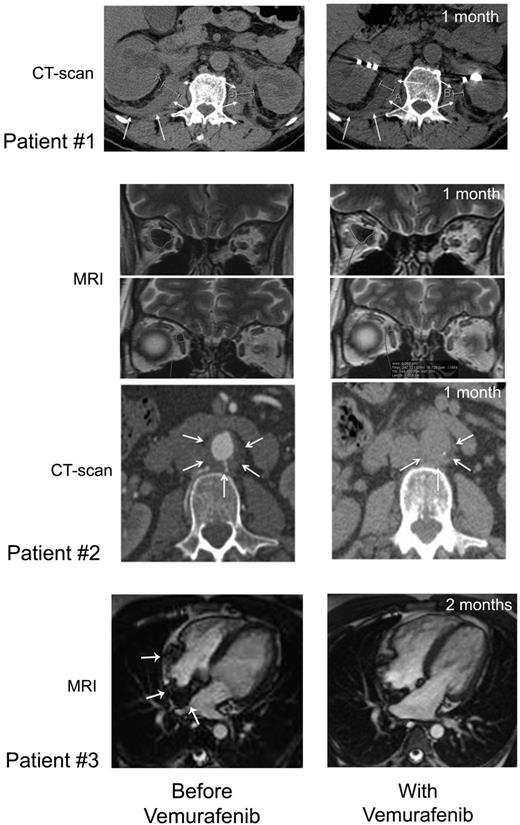 Figure 3. CT scan and MRI imaging assessment. Patient no. 1: Comparison of abdominal axial CT scans performed before (January 28, 2012; left) and on day 37 (May 23, 2012; right) of treatment showing regression of the infiltration around both kidneys (white arrows), evidenced by the decreased thickness (right kidney: 24.8 to 18.2 mm, left kidney 22 to 12.4 mm). Patient no. 2: Comparison of MRI performed before (left) and on day 36 (right) of vemurafenib treatment showing regression of ECD orbital infiltration. Comparison of abdominal axial CT scans performed before (March 29, 2012; left) and on day 39 (May 25, 2012; right) of vemurafenib treatment showing regression of the infiltration around abdominal aorta (white arrows): latero-aortic infiltration from 10.8 to 6.5 mm thick, and posterior infiltration from 6.5 to 4.6 mm thick. Patient no. 3: comparison of cardiac MRI, 4-chamber view: (A) February 21, 2012; see the infiltration of the atrial septum, the posterior wall and the free wall of the right atrium (white arrows); (B) July 19, 2012; note the regression of the infiltration.