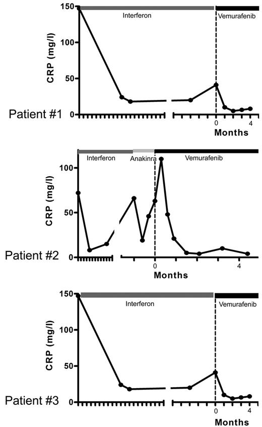Figure 4. Evolution of CRP levels under treatment. Patient no. 1: Blood CRP concentrations, correlating with initial response and secondary resistance to PEG-IFN treatment, and returning to normal values (< 5 mg/L) under vemurafenib. Patient no. 2: an initial CRP increase was associated with headaches and fever (39°C); CRP concentrations returned to normal values after 1 month of treatment. Patient no. 3: CRP concentrations returned to normal values after one month of treatment. Time 0 corresponds to initiation of vemurafenib treatment, and each graduation corresponds to 1 month.