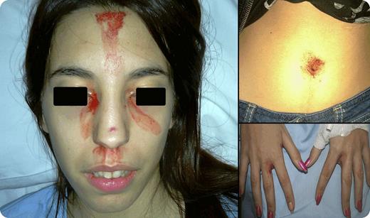 An 18-year-old woman presented with a 6-month mucocutaneous bleeding from the nose, lacrimal ducts, forehead, hands, nails, and navel. Initially bleeding episodes were infrequent, but increased to several times a day by the time of evaluation. Episodes were spontaneous, self-limited, and immediately preceded by intense headache and abdominal pain. Usually high stress was also present. There was no history of previous illnesses. Physical examination showed no signs of self-inflicted lesions. All laboratory, image, and coagulation tests, including platelet aggregation, were normal. More than 30 bleeding episodes were witnessed during hospitalization and samples of the fluid contained all normal blood cells. A skin biopsy, taken immediately after bleeding, was normal. Treatment with β-blockers was effective. Twenty months after diagnosis the patient has only rare bleeding episodes. / Hematidrosis is a rare phenomenon characterized by blood oozing from skin and mucosa. Although the pathologic mechanism remains unclear, it has been proposed that dermal defects may lead to blood-filled spaces that would exude into follicular canals or directly to the skin surface. The response to propranolol and association of stress with the bleeding episodes suggests the involvement of sympathetic nervous system activation in hematidrosis.