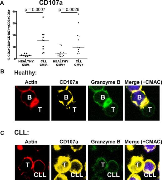 Figure 7. CD8+ T cells from CLL patients show defective cytotoxicity because of failure of granzyme localization to the immunologic synapse. The cytotoxic activity of CD8+ T cells from CLL patients was assessed further. (A) CD8+ T cells from CLL patients retain the ability to degranulate in response to SEB, as shown by their increased ability to transfer CD107a to the cell surface. (B) Healthy CD8+ T cells showed effective F-actin (red, rhodamine phalloidin) immunologic synapse formation with colocalization of CD107a (yellow, Alexa Fluor 647) and granzyme B (green, Alexa Fluor 488) at the synapse contact site with healthy B cells (+sAg). (C) In contrast, CD8+ T cells from CLL patients fail to form effective F-actin immune synapses with autologous CLL cells (+sAg) that is associated with strong, nonpolarized expression of CD107a and a lack of granzyme B polarization to the contact site.