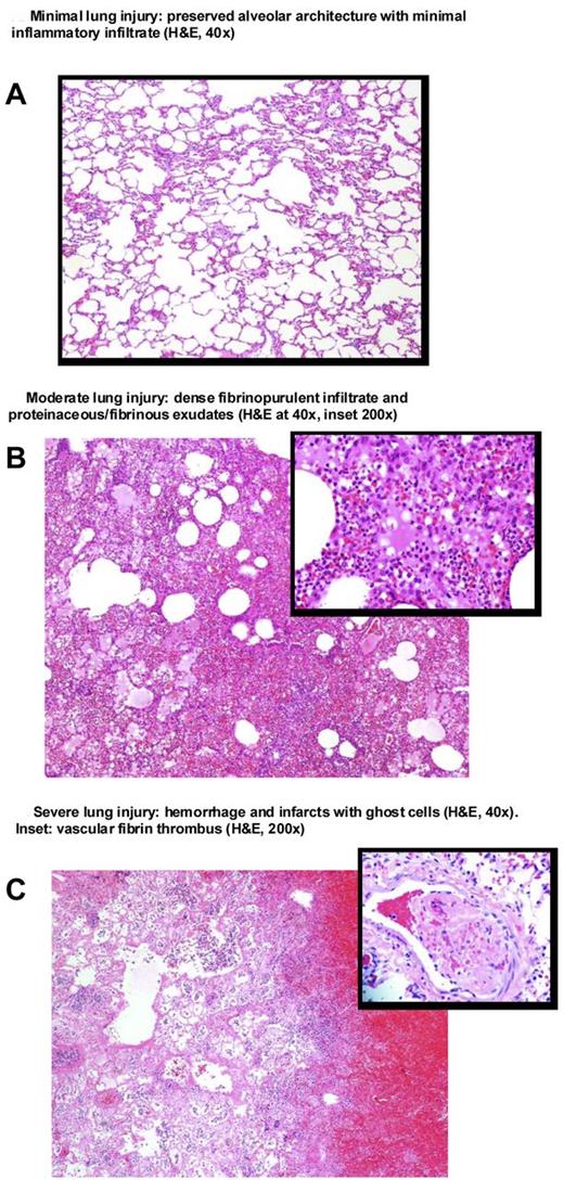 Figure 7. The degree of lung histopathology. Representative postmortem lung tissue samples showing typical minimal, moderate, and severe injury. The typical scores for tissue injury and inflammation in the right infected lung and left nonbacteria-challenged lung with older and newer blood transfusions are as follows: On the left, for nonbacteria-challenged lungs of these animals, the tissue injury scores (hemorrhage, necrosis, thrombosis) were median (range), older blood group 2 (1,2), and newer blood group 2 (1,4); on the right, for infected lungs, the scores were older blood group 3 (1,4) and newer blood group 2 (2,4). On the left, for nonbacteria-challenged lung of these animals, the inflammatory injury scores (neutrophils and fibrin deposition) were older blood group 4 (2,5) and newer blood group 4 (2,5). On the right, for infected lungs, the inflammatory injury scores were older blood group 4 (3-5) and newer blood group 4 (4-6).