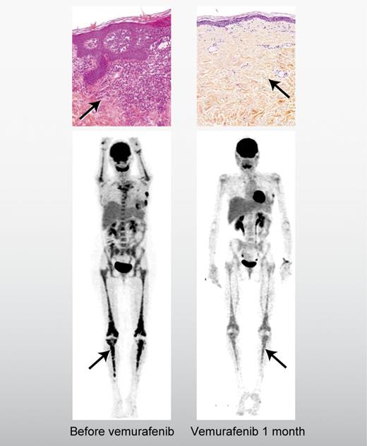 Saving orphans: BRAF targeting of histiocytosis. A patient with Langerhans cell histiocytosis in the skin (top panels) and Erdheim-Chester disease in the long bones (bottom panels) before and after treatment with vemurafenib.1 Professional illustration by Alice Y. Chen.
