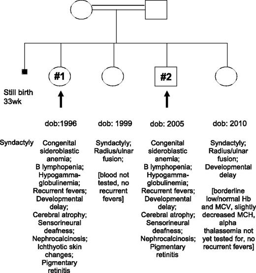 Figure 1. Pedigree for cases 1 and 2 with descriptions of phenotypes displayed. The other siblings unaffected by SA and immunodeficiency exhibited a different cluster of features consistent with the Cenani-Lenz syndrome.