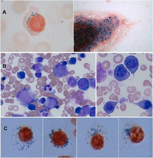 Figure 2. Photomicrographs of BM smears, demonstrating presence of ringed sideroblasts and erythroid hyperplasia with dyserythropoietic features. (A) Case 1 (Perl stain). (B) Case 11 (H&E). (C) Case 11 (Perl stain).