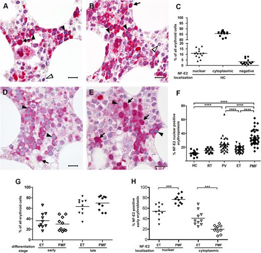 Figure 2. Immunohistochemistry of NF-E2 in HCs, RT, ET, PV, and PMF patients. (A-B represent HCs; D represents essential thrombocythemia; E represents PMF) Bone marrow biopsies were stained with an antibody against NF-E2 and counterstained with hematoxylin (original magnification ×1000; the bar indicates 20 µm). Arrows point to erythropoietic cells with nuclear NF-E2 staining, filled arrow heads indicate cytoplasmic NF-E2 staining, and open arrowheads mark cells negative for NF-E2 staining. (C,F-H) One hundred erythropoietic cells in each of 3 high-power fields per bone marrow biopsy (300 erythroid cells total) were evaluated for NF-E2 subcellular localization and/or differentiation stage. (C) Quantitative analysis of NF-E2 subcellular localization in HCs. Shown is the percentage of nuclear or cytoplasmic NF-E2–positive erythroid cells, respectively, and NF-E2–negative cells as a proportion of all erythroid precursors. (F) Quantitative analysis of nuclear NF-E2 positivity in erythroid cells in HC RT, and MPN patients. Shown is the percentage of nuclear NF-E2–positive erythroid cells as a proportion of all erythroid precursors. ****P < .0001 by 2-tailed Wilcoxon test. (G) Proportion of early and late erythroblasts of all erythroid cells in ET and PMF patients. Shown is the percentage of early and late erythroblasts as a proportion of all erythroid cells in ET and PMF patients. An early erythroblast was defined on a CAE stain as a CAE-negative erythroid cell with a small cytoplasm, a large nucleus (1.5-2.5–fold of the diameter of an erythrocyte), and 1 or 2 prominent nucleoli. A late erythroblast was defined as a CAE-negative cell, with abundant cytoplasm, frequently polygonal in shape, and with a round nucleus with dense chromatin. (H) Proportion of NF-E2 nuclear or cytoplasmic positive early erythroblasts in ET and PMF patients. Shown is the percentage of nuclear or cytoplasmic NF-E2–positive cells, as indicated, in early erythroid precursors. ***P < .001 by 2-tailed Wilcoxon test.