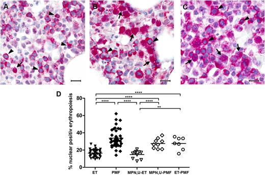 Figure 3. Immunohistochemistry of NF-E2 in MPN,U, ET, and PMF patients. Bone marrow biopsies were stained with an antibody against NF-E2 and counterstained with hematoxylin (original magnification ×1000, bar indicates 20 µm). Arrows point to erythropoietic cells with nuclear NF-E2 staining and filled arrowheads indicate cytoplasmic NF-E2 staining. (A) MPN,U later reclassified as ET. (B) MPN,U later reclassified as PMF. (C) ET later reclassified as PMF. (D) Quantitative analysis of NF-E2 immunohistochemistry in MPN,U patients. One hundred erythropoietic cells in each of 3 high-power fields per bone marrow biopsy were evaluated (300 erythroid cells in total). Shown is the percentage of nuclear NF-E2–positive erythroid cells as a proportion of all erythroid precursors. Data for ET and PMF are presented as in Figure 2F; **P < .01, ****P < .0001 by Wilcoxon test.
