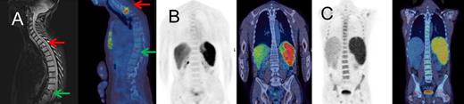 Figure 2. Example PET-CT images. (A) Focal FDG uptake in T2 on fused PET-CT sagittal image representing a DLBCL deposit (red arrow); no uptake at a compression fracture of T11 (green arrow) with confirmatory magnetic resonance image; iliac crest biopsy was negative. (B) Case with 10% diffuse DLBCL involvement on marrow histology, without increased FDG uptake in bone marrow. (C) Diffuse uptake throughout skeletal marrow, which was confirmed as DLBCL on marrow histology. The patient was HIV-positive with MYC and BCL2 abnormalities. PET and fused PET-CT coronal slices are shown.
