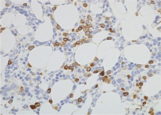 Figure 3. Iliac crest bone marrow histology. Photomicrograph (CD79a immunohistochemistry) from 1 of the 2 PET−/BMB+ patients. The interstitial infiltrate by DLBCL was patchy, as in this field, but overall CD79a-positive cells amounted to ∼10% of all nucleated marrow cells (Nikon Eclipse 80i microscope and camera; ×40 objective).