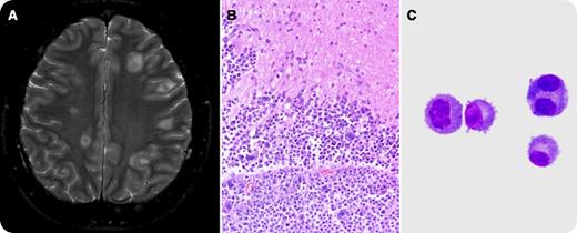 A 32-year-old man with an Ig A-λ plasma cell myeloma was diagnosed in early 2011. He underwent chemotherapy with bortezomib, doxorubicin, and dexamethasone and achieved a complete response. In August 2011, the patient underwent an autologous stem cell transplant with high-dose melphalan. The patient recovered uneventfully. / He presented in December 2011 with a severe headache requiring hospitalization. The patient had mild anemia (hemoglobin, 10.6 g/dL) but normal white blood cell and platelet counts. His calcium and creatinine levels were in the normal range. Bone marrow biopsy and serum protein electrophoresis/immunofixation were unremarkable. Computed tomography/magnetic resonance imaging scans of the brain showed multiple foci of hemorrhage with surrounding edema (panel A). A possible infectious etiology or embolic event was suspected clinically. An open excisional biopsy of the right frontal lesion of the brain was performed. The hematoxylin and eosin histologic sections showed brain parenchyma infiltrated by sheets of neoplastic cells with a plasmacytoid cellular morphology with round nuclei, prominent nucleoli, and abundant eosinophilic cytoplasm (panel B). Bi- or multinucleated tumor cells were frequent. The tumor cells were positive for CD138 and CD56 with λ light chain restriction, consistent with plasmacytoma. The cerebrospinal fluid (CSF) contained numerous neoplastic plasma cells (panel C). Isolated plasmacytoma of the brain with CSF involvement after a complete response from an autologous stem cell transplant is a rare event.