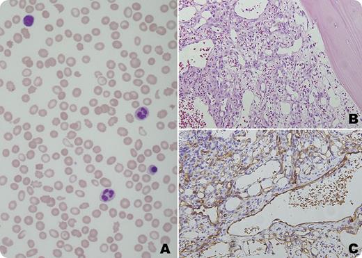 A 50-year-old man presented with marked thrombocytopenia (platelet count 14 × 109/L) in the setting of Child-Pugh B chronic liver disease secondary to hepatitis C infection and chronic alcohol consumption. The blood film demonstrated a microangiopathic hemolytic anemia (MAHA) with leukoerythroblastic and hyposplenic changes. Prominent red cell fragments, marked thrombocytopenia, nucleated red blood cells, acanthocytes, Howell-Jolly bodies, and target cells were seen (panel A). Radiological investigation with computed tomography and ultrasound scans demonstrated cirrhosis with evidence of portal hypertension and moderate splenomegaly with lesions consistent with hemangiomas. Bone marrow examination demonstrated effacement of normal marrow architecture with a vasoformative nonhematopoietic tumor comprising open vascular channels lined by a single layer of CD34+ endothelial cells (panels B and C). Extensive reticulin and collagen fibrosis was also observed. / The patient’s disease rapidly progressed and he died 2 weeks after the diagnosis of multiorgan failure. At autopsy, extensive splenic involvement with angiosarcoma was found and this is believed to be the site of origin. MAHA as a result of bone marrow involvement with metastatic splenic angiosarcoma is rarely described. Although chronic liver disease is a common cause of thrombocytopenia, marrow infiltrative disorders should be considered when leukoerythroblastosis and microangiopathy are present on the blood film.