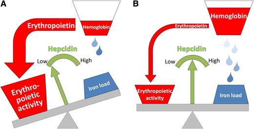 Hepcidin regulation in β-thalassemia major. Hepcidin production is modulated by suppressive effects of erythropoiesis and stimulatory effects of iron overload. (A) Before transfusion, exuberant erythropoietic activity suppresses hepcidin through an as yet poorly defined mechanism. Lower hepcidin would be expected to result in increased dietary iron loading. (B) After transfusion, ineffective erythropoiesis is alleviated, resulting in hepcidin de-repression. The effect of iron loading becomes apparent chronically rather than immediately after transfusion. Hepcidin measurements should help determine how well ineffective erythropoiesis is managed in β-thalassemia patients.