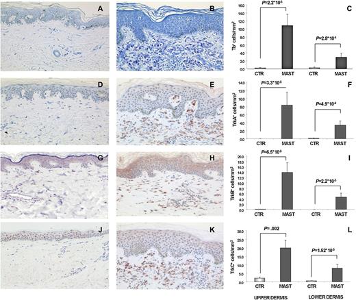 Figure 3. Increased number of MCs correlates with upregulated number of TrkA+, TrkB+, and TrkC+ cells infiltrating the dermis in CM. Toluidine blue (A-C), anti-TrkA (D-F), anti-TrkB (G-I), and anti-TrkC (J-L) staining of skin biopsies of healthy control participants (CTR) and patients with mastocytosis (MAST; lesional skin). Immunohistochemistry stainings of a representative paraffin section of healthy skin (A, D, G, J), CM (B, E, H, K), and mean values and SEMs of the number of cells in the upper (left side) and lower (right side) dermis of 10 control participants and 10 patients with mastocytosis (C, F, I, L: n = 5 for CM; n = 4 for ISM; and n = 1 for SM-AHNMD) are depicted.
