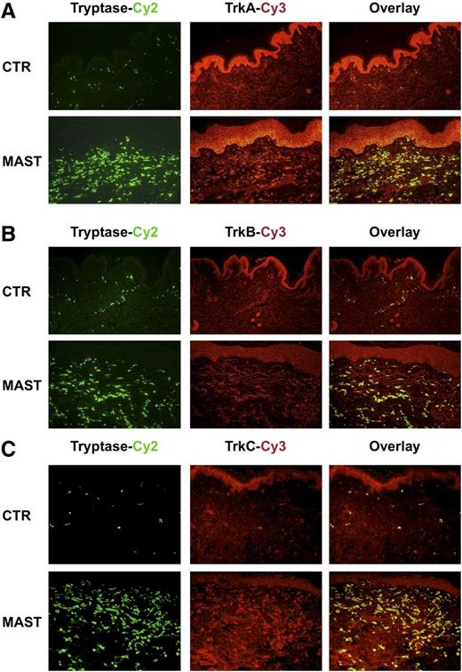 Figure 4. Immunofluorescence double staining identifies TrkA+, TrkB+, and TrkC+ cells infiltrating the skin of patients with mastocytosis as MCs. (A-C) Representative immunofluorescence double staining of skin biopsy taken from a healthy control patient (CTR) and a patient with mastocytosis (MAST) with an anti-tryptase antibody labeled with Cy-2 (green) and anti-TrkA, anti-TrkB, and anti-TrkC antibodies labeled with Cy-3 (red) and the overlay pictures of both stainings are shown.