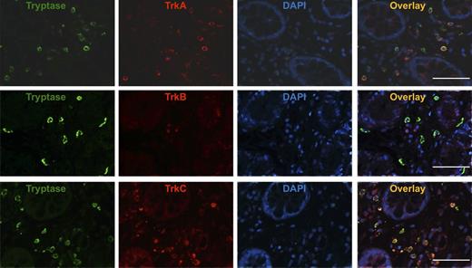 Figure 5. TrkA+ and TrkC+ MCs infiltrate the gut of patients with SM. Representative immunofluorescence double staining of gut sections (original magnification ×400) of patients with mastocytosis (MAST; n = 4) with an anti-tryptase antibody labeled with Cy-2 (green) and anti-TrkA, anti-TrkB, and anti-TrkC antibodies labeled with Cy-3 (red) overlay pictures of both stainings are shown. White bar = 50 µm.