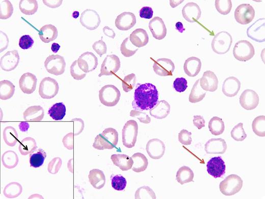 A 23-year-old primigravida woman presented with recurrent mucocutaneous bleeding since the age of 7 years. She was diagnosed with acute immune-mediated thrombocytopenia (ITP), and splenectomy was performed in 2006 after failure to respond to steroid therapy. Two close family members also had significant bleeding issues. Apart from pallor and a 20-weeks gravid uterus, there were no other physical findings. Complete blood count levels showed hemoglobin 5.6 g/L, hematocrit 21%, mean corpuscular volume 76.6 fL, mean corpuscular hemoglobin 20.6 pg, white blood cells 6.6 × 109/L, platelets 20 × 109/L, and mean platelet volume 9.1 fL. Peripheral blood film displayed hypochromic microcytes, macrothrombocytosis (red arrow), and postsplenectomy features such as target cells (green arrow), normoblasts (black arrow), and Howell-Jolly bodies (blue arrow). The platelet level estimate was low-normal on manual counting. Further laboratory workup showed a bleeding time of 5 minutes; ristocetin-defective platelet aggregometry with robust responses to collagen, epinephrine, and adenosine diphosphate; von Willebrand factor 157%; and ristocetin cofactor activity 150%. On the basis of family history, macrothrombocytosis, and platelet aggregometry, our presumed diagnosis was Bernard-Soulier Syndrome (BSS). / BSS is a rare autosomal, recessive platelet dysfunction. A peripheral film review is imperative for correct diagnosis because automated analyzers frequently fail to properly count the giant-sized platelets. Making a definitive diagnosis requires demonstration of absent GPIb-IX-V complex (flow cytometry or sodium dodecyl sulfate–polyacrylamide gel electrophoresis). However, a lack of sophisticated facilities restricted us from conducting such a workup.
