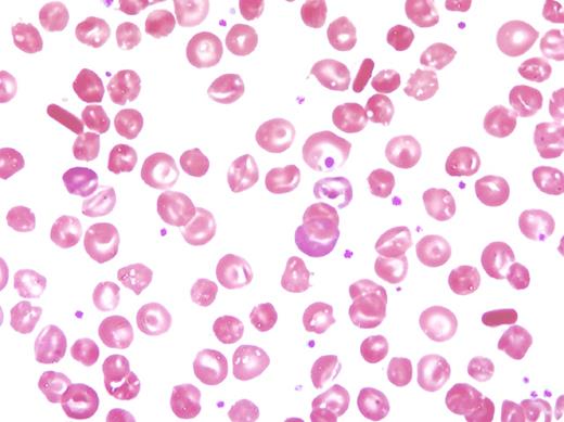 A 44-year-old African American female presented with a pain crisis and a history of hemoglobinopathy, menometrorrhagia secondary to acquired von Willebrand factor (vWF) deficiency, and a history of multiple vaso-occlusive events necessitating lifelong warfarin therapy. Further history revealed that she had four pain crises in the previous year requiring hospitalizations, multiple splenic infarcts with resultant autosplenectomy, one normal pregnancy with no preceding miscarriages, and no history of bone necrosis. Current symptoms include sternal pain, mild diffuse abdominal pain, and bilateral hip and knee pain causing difficulty with ambulation. Physical examination showed normal vital signs and cardiopulmonary function, nonpalpable liver and spleen, and pain with decreased range of motion of bilateral hip and knee joints. Complete blood count revealed a white blood cell count of 10.9 × 103/µL with normal differential, hemoglobin of 12.1 g/dL, platelet count of 794 × 103/µL, and reticulocyte count of 4.1%. Testing for the vWF revealed vWF antigen of 80%, vWF activity of 39%, and factor VIII activity of 120%. Peripheral blood smear showed microspherocytes, target cells, and hemoglobin crystals. Hemoglobin electrophoresis confirmed homozygous hemoglobin C. Upon admission to the hospital, she was started on intravenous fluids and pain medications, and her symptoms improved. / Although rare, vaso-occlusive events and acquired vWF deficiency have been reported in patients with nonhemoglobin S hemoglobinopathies. In patients with a peripheral blood smear showing microspherocytes, target cells, and hemoglobin crystals, homozygous hemoglobin C disease should be suspected.