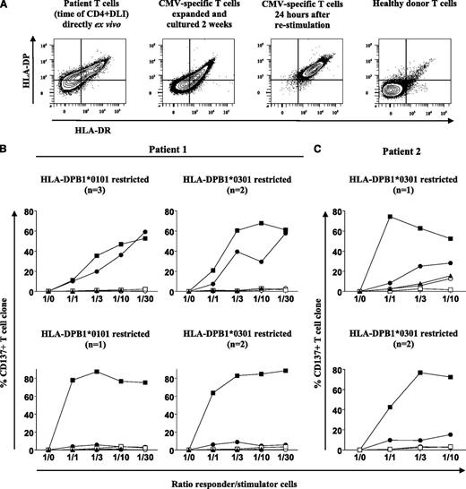 Figure 5. Recognition of residual patient-derived T-cells in PB before CD4+ DLI by allo-reactive HLA-DPB1–specific CD4 T-cell clones. (A) Coexpression of HLA-DR and HLA-DP on CD3+ T cells in cryopreserved PBMCs from patient 1 before CD4+ DLI and on patient-derived CMV-specific T cells after 2 weeks of in vitro expansion and 24 hours after restimulation with CMV antigens was determined by flow cytometry. As a control, expression of HLA-DR and -DP is shown for healthy donor CD3+ T cells. (B-C) Activation of HLA-DPB1–specific CD4+ T-cell clones from patient 1 (B) and patient 2 (C) was measured upon stimulation with patient-derived T cells after direct ex vivo isolation from cryopreserved PBMCs (-▲-), patient-derived CMV-specific T cells after 2 weeks of in vitro expansion (-○-), and 24 hours after in vitro restimulation with CMV antigens (-●-) and against patient (-▪-) and donor (-□-) EBV-LCL. Activation was measured 24 hours after stimulation by flow cytometric staining for CD137. Percentages of activated CD137+ cells are depicted for different CD4+ T-cell clones at different responder/stimulator cell ratios. Responder/stimulator cell ratio 1/30 could not be tested for patient-derived T cells after ex vivo isolation from cryopreserved PBMCs because of insufficient material. In total, 4 HLA-DPB1*0101– and 4 HLA-DPB1*0301–specific CD4+ T-cell clones from patient 1 (B) and 3 HLA-DPB1*0301–specific CD4+ T-cell clones from patient 2 (C) were analyzed. No or only minimal activation of HLA-DPB1–restricted CD4+ T-cell clones was observed upon stimulation with patient-derived T cells after direct ex vivo isolation and patient-derived CMV-specific T cells after 2 weeks of in vitro expansion. Upon stimulation with patient-derived CMV-specific T cells 24 hours after in vitro restimulation with CMV antigens, however, 3 HLA-DPB1*0101–specific and 2 HLA-DPB1*0301–specific CD4+ T-cell clones from patient 1 (B, upper) and 1 HLA-DPB1*0301–specific CD4+ T-cell clone from patient 2 (C, upper) were activated, whereas the remaining HLA-DPB1–restricted CD4+ T-cell clones from patient 1 (B, lower) and patient 2 (C, lower) were not or were only minimally activated.
