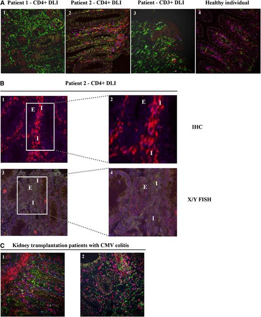 Figure 6. T-cell infiltrate and HLA class II expression in colonic biopsies. (A) Multicolor immunofluorescent stainings for CD3 (clone PS1, IgG2a + IgG2a ALEXA 546) (red), CD8 (clone 4B11, IgG2b + IgGb ALEXA 647) (blue), and HLA class II (clone CR3/43, IgG1 + IgG1 ALEXA 488) (green) were performed on colonic biopsies from patient 1 (1) and patient 2 (2) obtained at the time of GVHD diagnosis after CD4+ DLI, a patient diagnosed with colonic GVHD after CD3+ DLI (3), and a normal colon from a healthy individual (4). Double CD3+CD8+ cells (purple) were defined as CD8+ T cells, whereas CD3+CD8-expressing cells (red) were defined as CD4+ T cells. Images were captured with a confocal laser scanning microscope (LSM510; Zeiss, Sliedrecht, The Netherlands) (original magnification ×200) (supplemental Methods). Numbers of CD4+ and CD8+ T cells were enumerated by a third party in a blinded fashion, and tissue sections showed CD4/CD8 ratios of 0.9, 1.5, 0.4, and 0.8 for images 1, 2, 3, and 4, respectively. (B) Combined immunofluorescent stainings for CD3 (clone PS1, IgG2a + IgG2a ALEXA 546) (red) and CD8 (clone 4B11, IgG2b + IgGb ALEXA 647) (blue) (1-2), and FISH analysis for detection of X (green) and Y (red) chromosomes (XX/XY) (3-4) were performed on serial sections of the colonic biopsy from patient 2 (male; URD = female). Immunofluorescent staining: original magnification ×200 (1) and framed area, original magnification ×400 (2). Corresponding fields in X/Y FISH analysis: original magnification ×200 (3) and framed area, original magnification ×400 (4). Interstitium (I) and colonic epithelial cells (E) are indicated in the stainings. Colonic epithelial cells show recipient-specific XY karyotype, whereas interstitial T-cell infiltrate predominantly shows donor-specific XX karyotype. Control normal male colonic biopsy was also examined by X/Y FISH (data not shown). All slides were digitized using a Mirax slide scanner (3DHISTEC, Budapest, Hungary) and analyzed using Panoramic Viewer (3DHistec, version 1.14.50 RTM) (supplemental Methods). (C) Immunofluorescent stainings (original magnification ×200) for CD3 (red), CD8 (blue), and HLA class II (green) on colonic biopsies from 2 kidney transplantation patients (1-2) with CMV colitis. Enumeration of CD4+ and CD8+ T cells showed CD4/CD8 ratios of 2.3 and 0.5 for images 1 and 2, respectively.