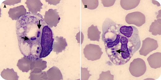 A 78-year-old woman hospitalized for investigation of ascites presented with weakness, loss of appetite, fever, and chills. A complete blood count showed anemia, leukocytosis, and thrombocytopenia (hemoglobin, 8.5 g/dL; leukocytes, 27.5 × 109/L; platelets, 50 × 109/L). Peripheral blood smear demonstrated the presence of neutrophilia with left shift (promyelocytes, 0.3 × 109/L; myelocytes, 1.9 × 109/L; metamyelocytes, 2.2 × 109/L; band neutrophils, 2.2 × 109/L; and segmented neutrophils, 19.7 × 109/L) and distorted granulocytes containing toxic vacuoles and intracellular structures that exhibit a uniform and definite rod shape (arrows), suggestive of phagocytized bacilli (panels A-B). Blood cultures confirmed the blood smear findings and revealed the presence of 2 species of bacillus, Klebsiella pneumoniae and Pseudomonas aeruginosa. / The finding of microorganisms in peripheral blood smear is unusual and should be regarded as a useful indicator of overwhelming infection, supporting an early and definitive diagnosis of septicemia. Although several species of bacteria have been described on examination of peripheral blood smears, detection of bacteremia due to gram-negative rods on a blood film has rarely been reported.