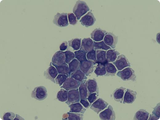A 70-year-old woman presented with 4 weeks of progressive bilateral lower extremity weakness. She had past medical history of stage III diffuse large B-cell lymphoma treated with 6 cycles of R-CHOP chemotherapy, which was completed 6 months prior to presentation. All risk factors for central nervous system (CNS) relapse were negative except for thickening of left paranasal sinus. A computed tomography scan after chemotherapy revealed complete resolution of primary disease. On presentation, physical examination was unremarkable except for motor weakness of lower limbs. Magnetic resonance imaging lumbosacral spine revealed signal changes in the cauda equina and contrast enhancement in the lower subarachnoid space. Cerebrospinal fluid (CSF) cytology revealed large malignant lymphoid cells with abundant cytoplasm and prominent punched out nucleoli. Immunostains were positive for B-cell markers. A diagnosis of isolated leptomeningeal CNS relapse was made, as restaging scans were negative for disease at systemic sites. Intrathecal triple therapy (methotrexate, cytarabine, and dexamethasone) was given; subsequent CSF showed a remarkable reduction in the lymphoid cells and the patient clinically improved. / Involvement of the CNS is an infrequent but fatal complication of diffuse large B-cell lymphoma. It is widely accepted that due to the low incidence of CNS relapse, prophylactic measures in all diffuse large B-cell lymphoma patients cannot be recommended.