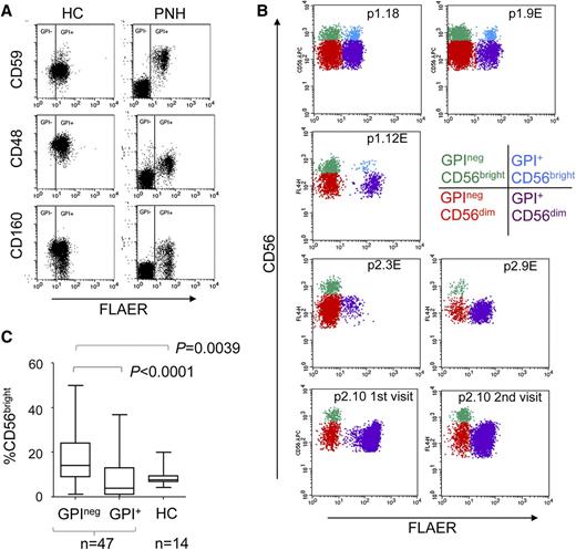 Figure 1. Altered NK cell subset homeostasis in PNH. (A) Cell surface expression of the GPI-linked proteins CD48, CD59, and CD160 on the NK cells (gated on CD56+CD3neg cells) of a healthy control (HC) and a PNH patient. Staining with fluorescent aerolysin (FLAER) demarcates GPI+ from GPIneg cells. (B) CD56bright and CD56dim NK cell subsets present in the peripheral blood of PNH patients (plots gated on CD56+CD3neg cells). The top 2 rows show 3 patients with all 4 subsets of NK cells (denoted p1.number), and the bottom 2 rows show 3 patients in which the GPI+CD56bright NK cells made up less than 0.02% of the total GPI+ NK cells (denoted p2.number). The 4 subsets of NK cells are indicated in different colors, according to the key. NK cells from p2.10 were analyzed on 3 occasions; the first 2 visits are shown here, and the third visit, together with sequential analysis of 3 other patients, is shown in supplemental Figure 2. Across the cohort of 47 patients, the size of the GPIneg NK cell population varied from ∼1% to ∼99% of the total NK cells (supplemental Figure 1), in agreement with previous findings.8 An “E” after the patient number indicates the patient was receiving eculizumab at the time of analysis. (C) Frequency of CD56bright NK cells as a percentage of total GPIneg or total GPI+ NK cells compared with healthy controls. P values (calculated using the Mann-Whitney nonparametric test) are shown for statistically different data.