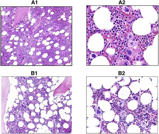 Figure 2. Comparison of PV vs ET marrow morphology. Shown are hematoxylin and eosin sections of study cases showing typical PV vs ET morphology. (A1) PV: ×200 magnification. Hypercellular marrow with panmyelosis. (A2) PV: ×400 magnification of the same case. Note the pleomorphic megakaryocytes in loose clusters. (B1) ET: ×200 magnification. Normocellular marrow with increased megakaryopoiesis. (B2) ET: ×400 magnification of the same case. Note the large hyperlobulated megakaryocytes lacking significant pleomorphism.
