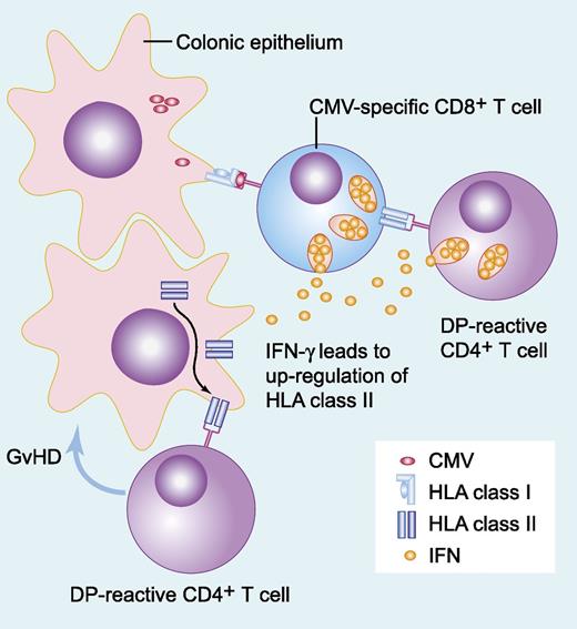 CMV-specific T cells recognizing virus in the context of MHC-I molecules secrete inflammatory cytokines, resulting in upregulation of MHC-II molecules both on the potential colonic targets of alloreactive DP-mismatched CD4+ T cells and on the CMV-specific T cells themselves. Recognition of these mismatched MHC-II molecules results in eradication of recipient-derived CMV-specific immunity and induction of local tissue damage (GVHD), with or without recruitment of further immune effector populations. IFN, interferon. Professional illustration by Paulette Dennis.