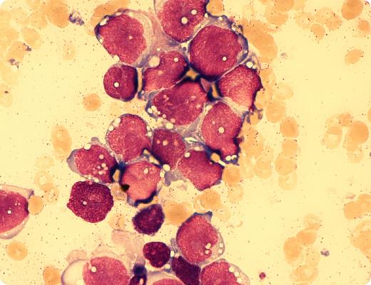 In March 2012, a 31-year-old male patient was diagnosed with alveolar rhabdomyosarcoma (ARMS) manifesting within the left sinus maxillaris with local lymphonodular metastases. No further metastases could be found by positron emission tomography–magnetic resonance imaging. He was treated by neo-adjuvant chemotherapy and consecutive radical endonasal resection and reconstruction in July 2012. In November 2012, he developed severe grade IV pancytopenia. Bone marrow aspiration revealed total bone marrow infiltration by cells with heavily vacuolated bluish cytoplasm similar to myelo-/lymphoblasts (magnification, ×100; May-Giemsa-Grünwald stain). Normal hematopoietic elements were absent. Immunohistochemistry in trephine biopsy showed a high expression of desmin. The patient received 5 cycles of palliative chemotherapy. The blood counts improved significantly with normal leukocyte and thrombocyte count. However, after 4 cycles of chemotherapy, bone marrow biopsy revealed 60% infiltration by the rhabdomyosarcoma. / Compared with embryonal rhabdomyosarcoma (ERMS), ARMS has a dismal prognosis and often presents with metastases at diagnosis. Explanations for the more aggressive course, different response to chemotherapy, and much shorter overall survival compared with ERMS might be that ARMS harbors a recurrent translocation involving either the PAX3 or PAX7 and FOXO1 genes leading to fusion transcripts, which likely plays a role in the more aggressive phenotype over ERMS.