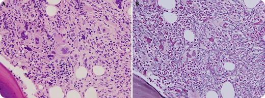 A 55-year-old woman with chronic refractory idiopathic thrombocytopenic purpura (ITP) presented with gum bleeding for 1 day. Over the course of several years, she had failed, or became resistant to, multiple treatments including glucocorticoids, intravenous immunoglobulin, splenectomy, rituximab, and, recently, a 9-month course of weekly romiplostim with moderate compliance. A complete blood count showed mild leukocytosis (white blood cells, 16.2 × 109/L), severe anemia (hemoglobin, 6.7 g/dL), and severe thrombocytopenia (platelet count, 12 × 109/L). Examination of a bone marrow specimen obtained to evaluate her unxplained worsening cytopenias revealed hypercellular marrow with a cellularity of 80%, trilineage hematopoiesis, and increased numbers of pleomorphic megakaryocytes (panel A). A reticulin stain demonstrated diffuse moderate to severe reticulin fibrosis (MF2-MF3; panel B). A diagnosis of romiplostim-induced myelofibrosis was established, and the medication was discontinued. Thrombocytopenia responded to danazol and an increase in the dose of glucocorticoids, and bleeding resolved. / Secondary myelofibrosis occurs in ∼3% of patients treated with thrombopoietin receptor agonists such as romiplostim and is usually reversible and dose dependent. Amplified megakaryocyte-fibroblast interactions and increased levels of cytokines such as transforming growth factor-β in the bone marrow due to chronic thrombopoietin stimulation have been implicated in romiplostim-induced reticulin myelofibrosis.