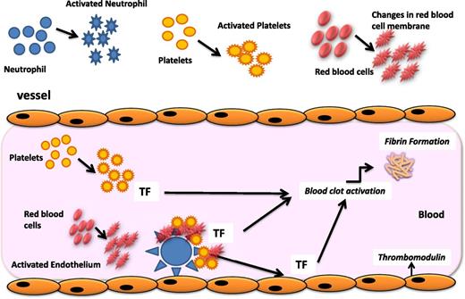 Figure 1. Pathogenesis of thrombophilia in MPN. The pathogenesis of the acquired thrombophilic state in ET and PV is multifaceted. Mechanisms involved in the pathogenesis of the acquired thrombophilic state associated with these diseases include abnormalities of MPN-clone–derived blood cells (ie, erythrocytes, platelets, and leukocytes), which display prothrombotic features, and abnormalities of normal vascular cells, which become procoagulant in response to inflammatory stimuli. Once activated, neutrophils can also affect the hemostatic system through different pathways. In particular, the release of proteolytic enzymes and of reactive oxygen species can activate or damage platelets and endothelial cells and impair some coagulation proteins. Activated platelets express P-selectin and tissue factor (TF) and release MPs. The increased expression of CD11b on the neutrophil surface allows the adhesion of neutrophils to endothelial cells and platelets and the assembly of coagulation proteases on the neutrophil surface. In addition, abnormalities in red blood cells (RBC), including biochemical changes in the cell membrane and content, may independently impair blood flow also through the formation of RBC aggregates. Furthermore, RBC aggregation facilitates the platelet and leukocyte interaction with the vessel wall.