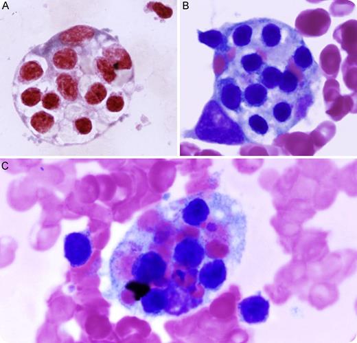 A 73-year-old male with a medical history of chronic lymphocytic leukemia (CLL) with urinary infection presented with fever (101.6°F) and pancytopenia (white blood cells 1.0 K/μL, platelets 54 K/μL, and hemoglobin 7.8 g/dL). Viral and fungal studies were negative. A bone marrow study was performed and showed persistent CLL and the presence of numerous phagocytosed lymphocytes and red blood cells by histiocytes. The figure shows characteristic engulfed red blood cells and lymphocytes by histiocytes (panel A: iron stain; panels B-C: Wright-Giemsa stain). Further laboratory tests demonstrated elevated ferritin (45 077 mg/dL), hypertriglyceridemia (4 mmol/L), hypophosphatemia (0.5 g/L), and hepatocellular pattern of transaminitis. The clinicopathological findings of this patient met the diagnostic criteria of hemophagocytic syndrome or hemophagocytic lymphohistiocytosis (HLH), a systemic, progressive, and often fatal disorder. Clinical improvement was observed after the patient was treated with etoposide and dexamethasone. / Two major forms of HLH have been described, familial (FHLH) and secondary or acquired (AHLH). FHLH is an autosomal recessive disorder prevalently seen in parental consanguinity. AHLH occurs secondary to systemic infection, immunodeficiency, and underlying malignancy, such as CLL in this patient. Treatment with immunosuppressive and/or chemotherapeutic agents might alleviate the disorder, although poor clinical outcomes of HLH were reported when associated with hematologic malignancies.