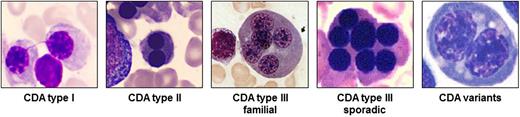 Figure 1. Pathognomonic marrow erythroblasts. The BM erythroblasts morphology (light microscopy) of different types of CDA is shown. See Table 1 for the description.